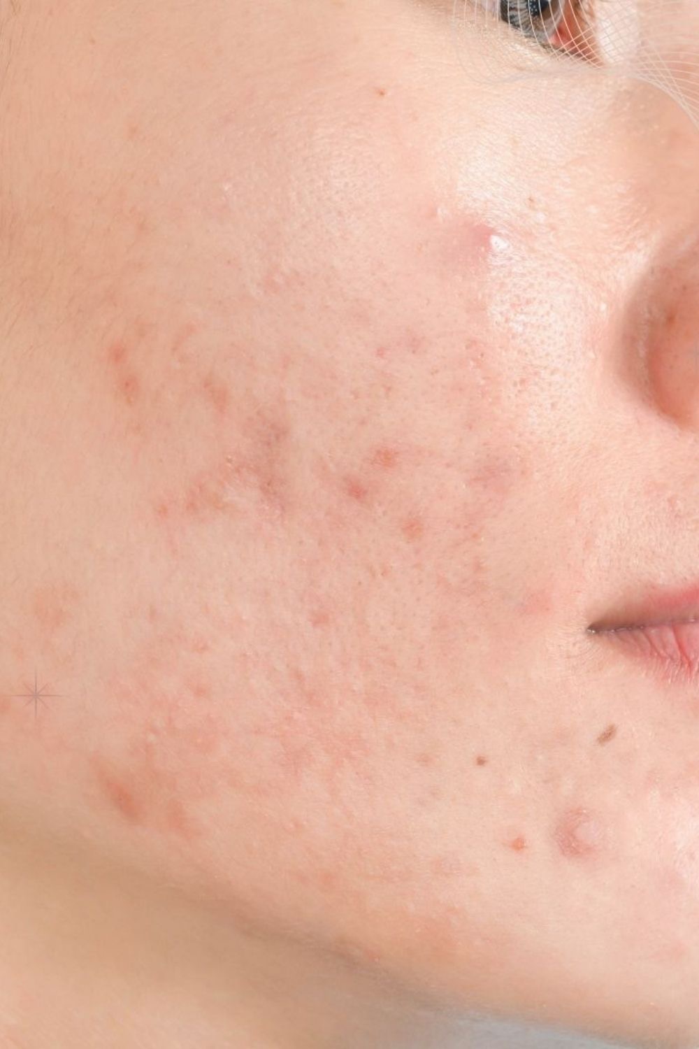 Fungal Acne Demystified 5 Crucial Aspects Causes Symptoms Diagnosis Effective Treatment 